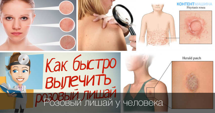 Розовый лишай