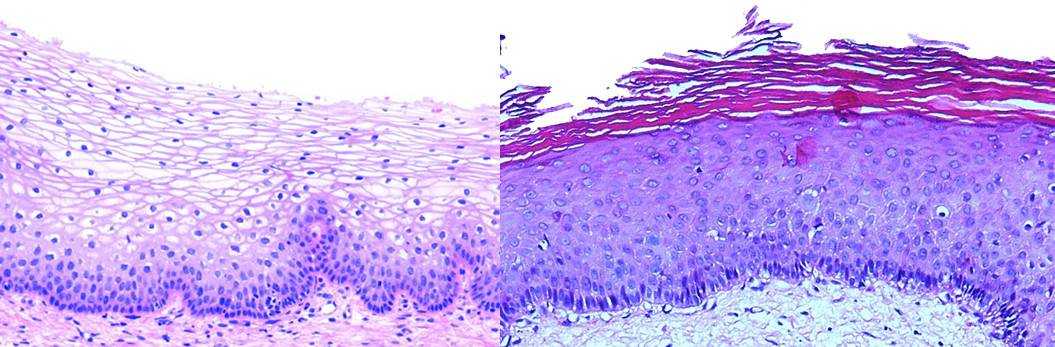 Паракератоз в мазке на цитологию что. Паракератоз гистология. Гиперкератоз плоский эпителий матка. Гиперкератоз гистология. Плоский эпителий матки паракератоз.
